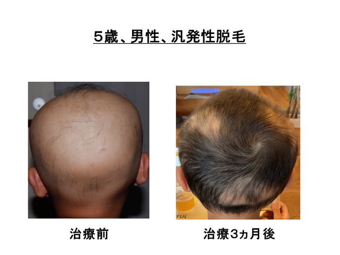 円形脱毛症　病院